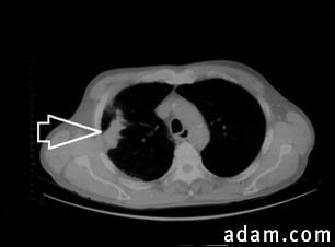 Lung mass, left lung - CT scan