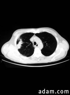 Lung with squamous cell cancer - CT scan