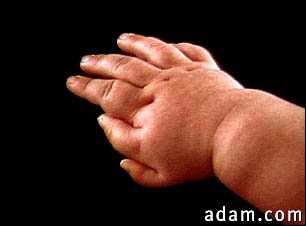 Polydactyly - an infant's hand
