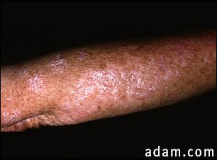 Actinic keratosis on the arm