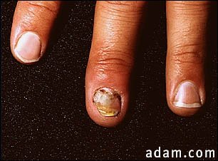 Nail infection, candidal