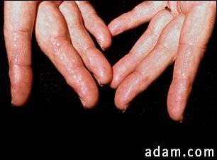 Amyloidosis on the fingers