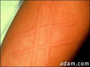Dermatographism on the arm