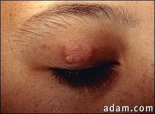 Granuloma annulare on the eyelid