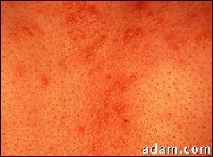 Sarcoid - close-up of the skin lesions