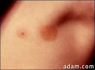 Urticaria pigmentosa in the armpit