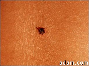 Tick imbedded in the skin