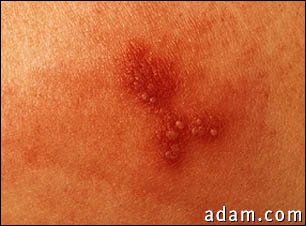 Herpes simplex - close-up