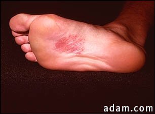 Dermatitis, nickel on the sole