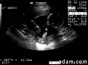 Ultrasound, normal fetus - arm and legs