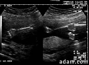 Ultrasound, normal fetus - arms and legs