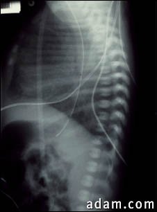 Totally anomalous pulmonary venous return, X-ray