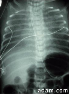 Totally anomalous pulmonary venous return, X-ray