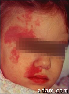 Port wine stain on a child's face