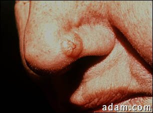 Skin cancer, basal cell carcinoma - nose