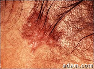 Skin cancer, basal cell carcinoma - pigmented