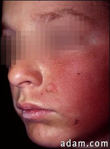 Dermatitis, contact on the cheek