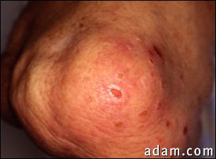 Dermatitis, herpetiformis on the elbow