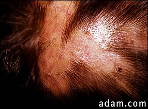 Folliculitis, decalvans on the scalp