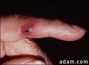 Janeway lesion on the finger