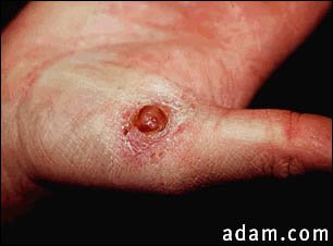 Pyogenic granuloma on the hand