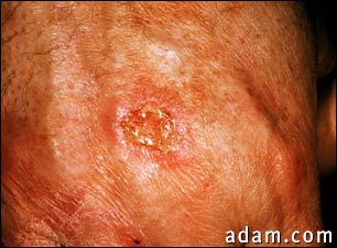 Skin cancer, squamous cell - close-up