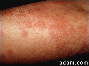 Hives (urticaria) on the arm