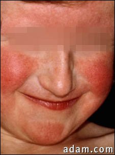 Dermatitis, atopic on a young girl's face