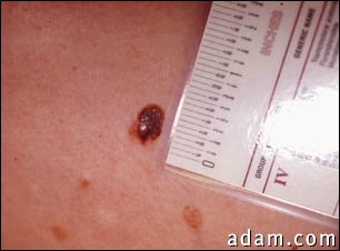 Skin cancer, close-up of level III melanoma