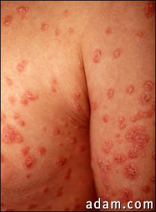 Psoriasis, guttate on the arms and chest