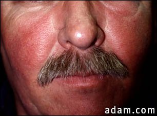 Systemic lupus erythematosus rash on the face