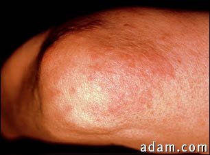 Granuloma, annulare on the elbow