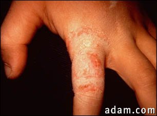 Ringworm, tinea manuum on the finger