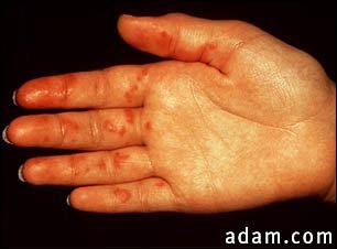 Vasculitis on the palm