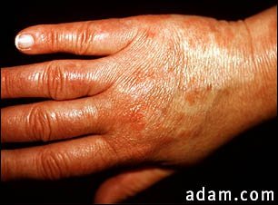 Vasculitis, urticarial on the hand