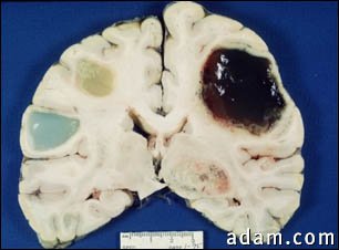 Brain tumor