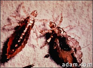 Lice, body with stool (Pediculus humanus)