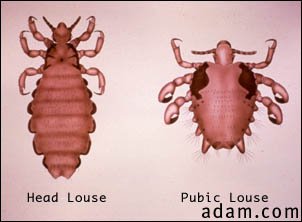 Head louse & pubic louse