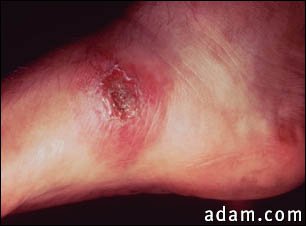 Leishmania panamensis on the foot