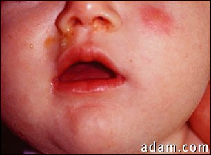 Septicemia, pseudomonas on the face