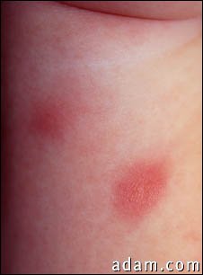 Septicemia, pseudomonas - close-up