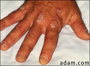 Psoriasis on the knuckles