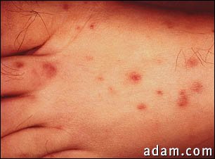 Rocky mountain spotted fever on the foot