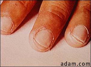 Kawasaki's disease, peeling of the fingertips