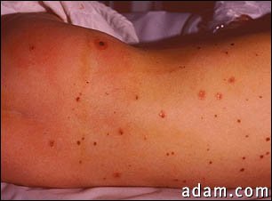 Meningococcal lesions on the back