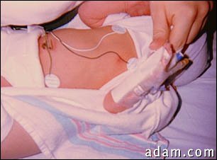 Intravenous catheter in a newborn arm