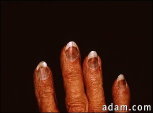 Cryoglobulinemia - fingers