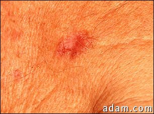 Basal Cell Carcinoma - close-up