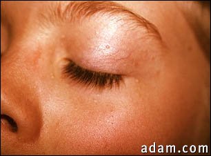Basal cell nevus syndrome