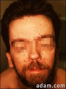 Basal cell nevus syndrome - face